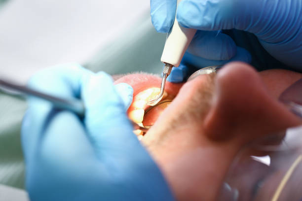 Best Chipped Tooth Repair Near Me  in Washington, IA