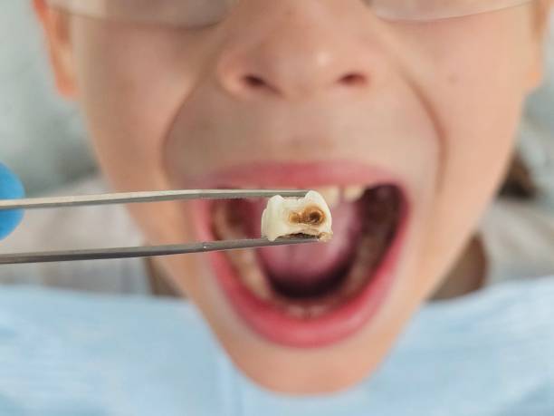 Best Urgent Tooth Repair  in Washington, IA