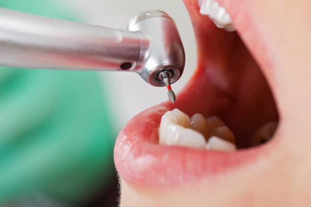 Best Cracked Tooth Emergency Dentist  in Washington, IA